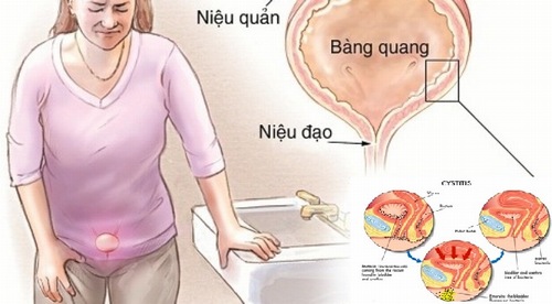 chữa các bệnh về bàng quang